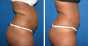 Before & After Photos